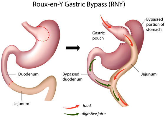 laparoscopic Roux-en-Y gastric bypass